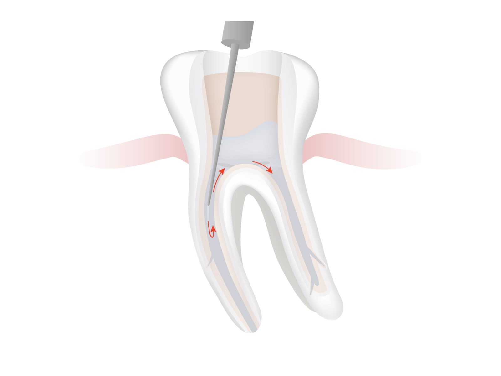 Spülung mit Desinfektionsmittel