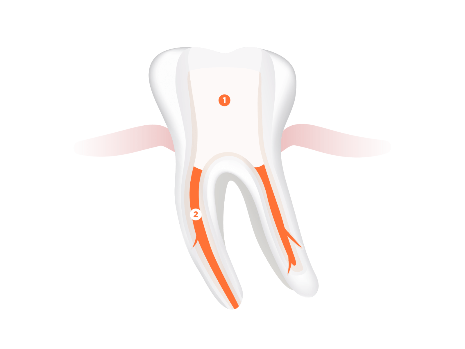 Füllung und Wurzelfüllmaterial